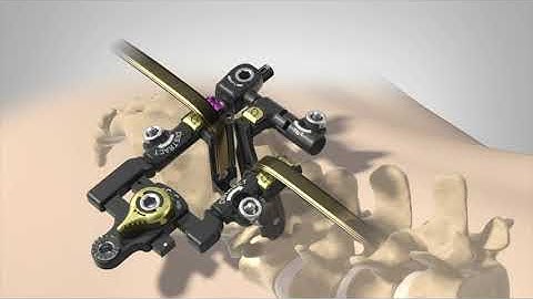 MAS TLIF animation (Japan)