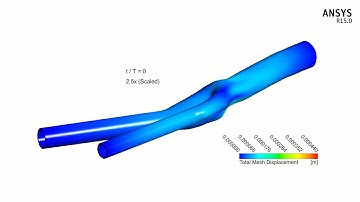 Fluid-Solid interaction simulation: Patient-specific Common Carotid Artery Bifurcation
