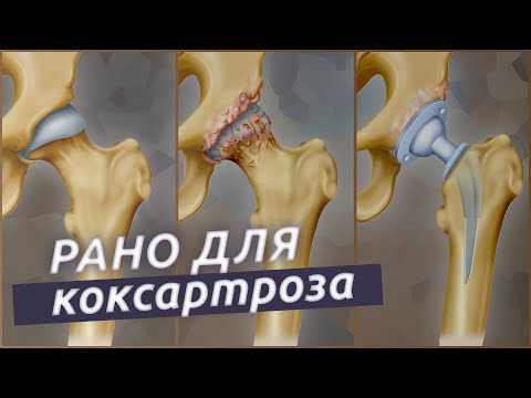 Боль в бедре это коксартроз? Как не допустить замену сустава?