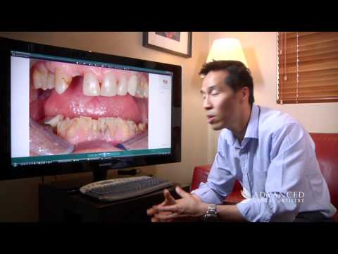 advanced-dental-artistry---broken-teeth-new-smile---perth-cosmetic-and-dental-implant-team