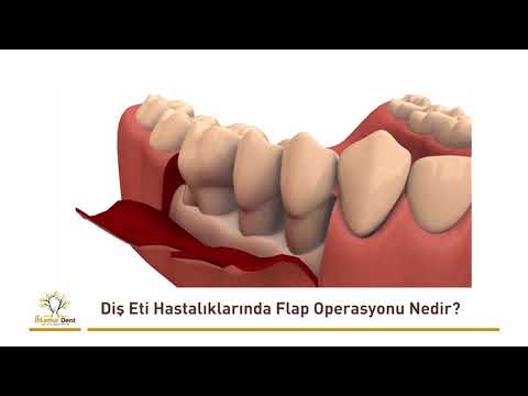 Diş Eti Hastalıklarında Flap Operasyonu Nedir?