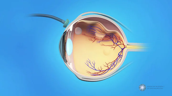 Vitrectomy Surgery for Detached Retina - DayDayNews