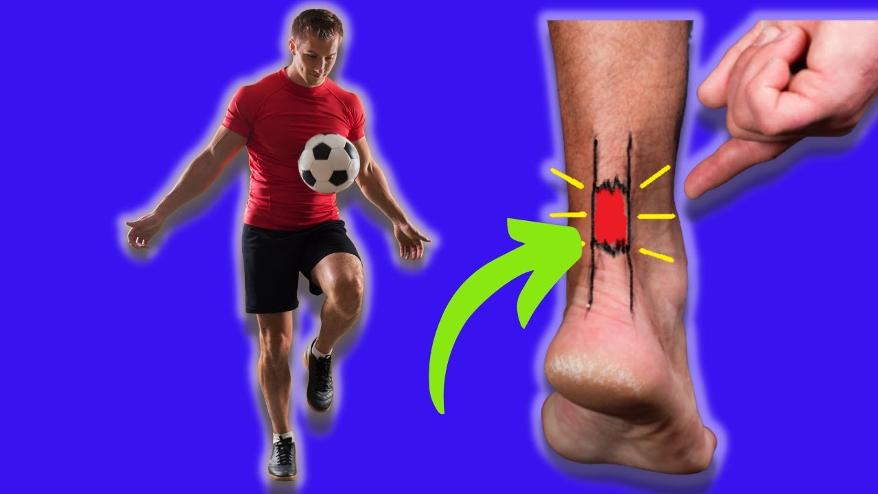 Achilles Tendon Rupture: When Can I Return to Sport?
