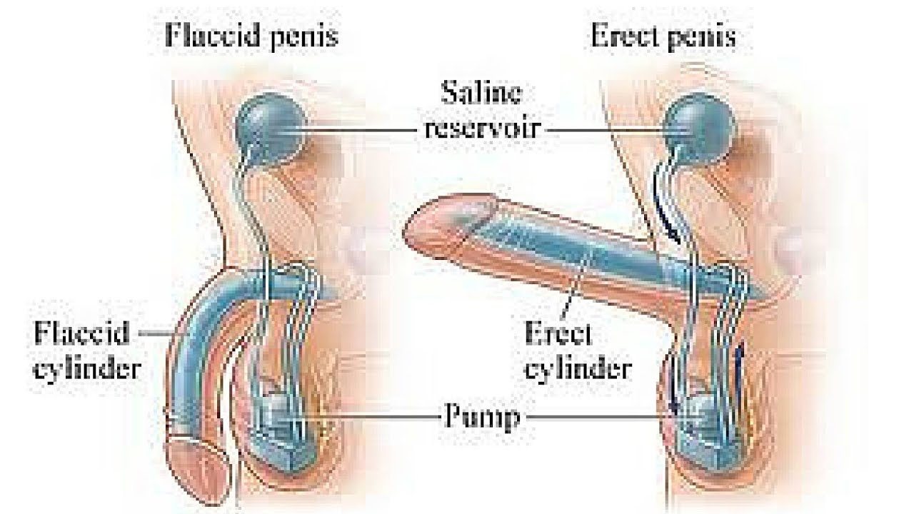 Erectile Dysfunction Porn Video