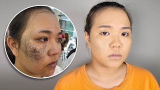 CHE VẾT CHÀM ĐƠN GIẢN HIỆU QUẢ KHÔNG CẦN TRIỆT SẮC/Hùng Việt Makeup