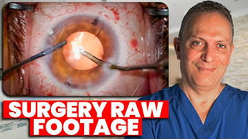 Witness Cataract Surgery Live on Camera! (STEP-BY-STEP)