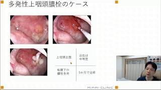 医師解説【本当に治る？】慢性上咽頭炎の治り方【EAT治療】その8