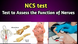 NCS Test ( Nerve Conduction Study) Procedure.