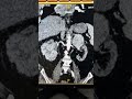 Renal Cell Carcinoma in CT Scan | Kidney Cancer #shorts