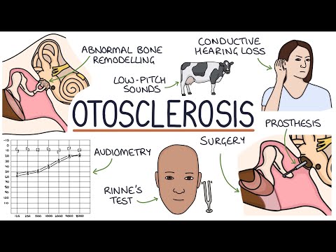 Understanding Otosclerosis — video thumbnail