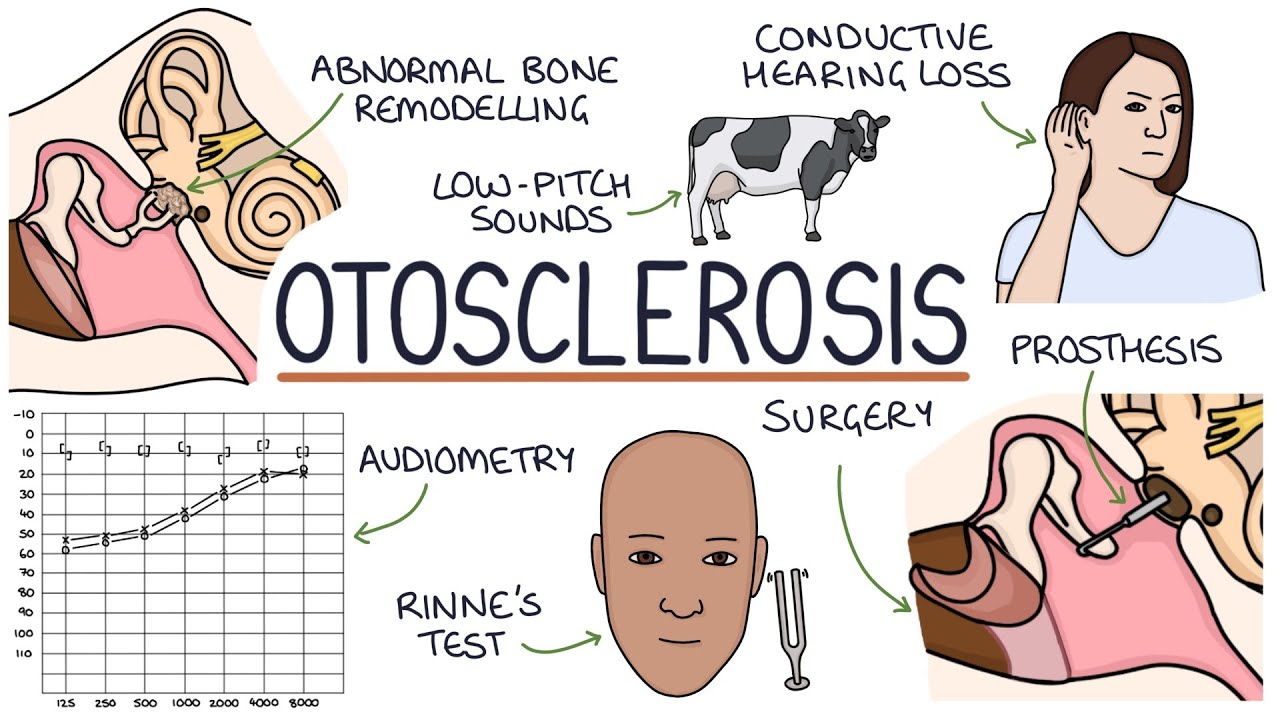 What Is Otosclerosis? Symptoms & Diagnosis