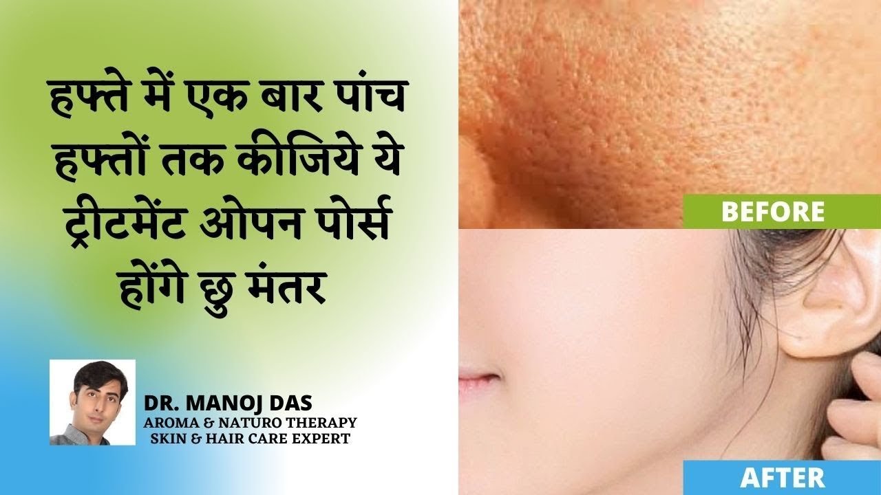सिर्फ 2 USES में खत्म Clogged Pores, Blackheads, Bumps, Whiteheads and Large Pores I DR. MANOJ DAS