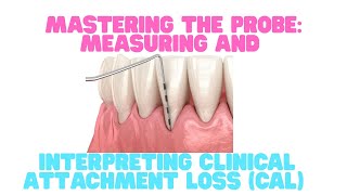 Mastering the Probe: Measuring and Interpreting Clinical Attachment Loss (CAL)