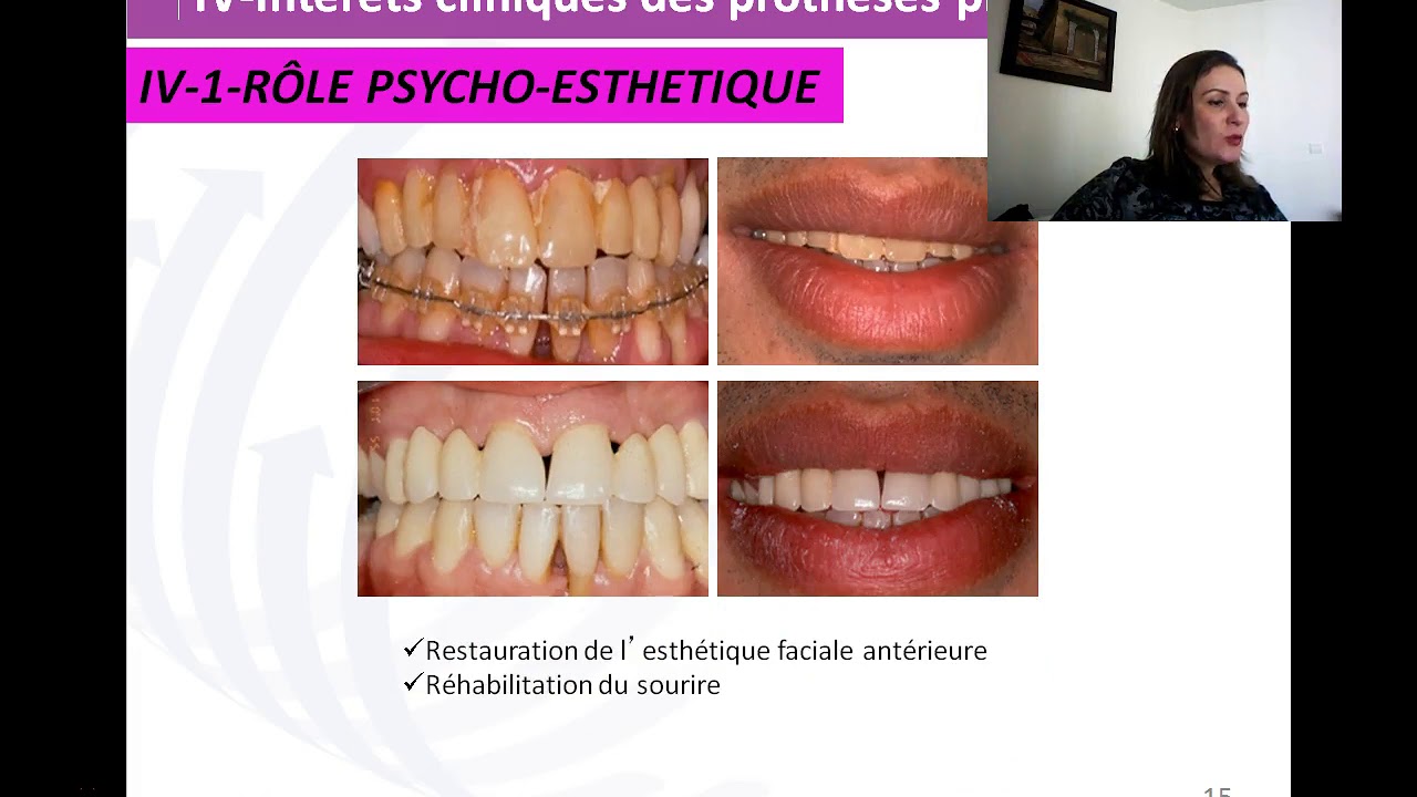 Prothèse provisoire en prothèse conjointe