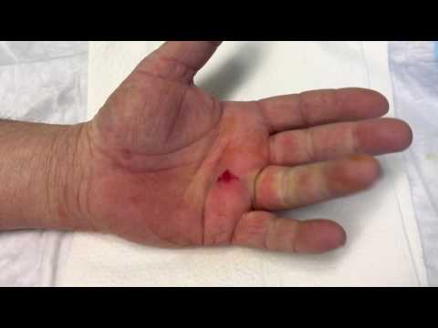 Dr Mora-Simple Trigger Digit Release