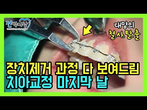 2-10.대망의 철.사.탈.출🤘 철사 장치제거하는 과정 전부 다 보여드릴게요❗ 치아교정 마지막 날 The end