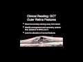 Identifying Important Outer Retinal and Sub-RPE Findings via OCT