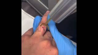 Laser Tattoo Removal Process with the PicoWay Laser