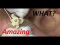 #26 # BIG CYST on the ears. BLACKHEADS and WHITEHEADS for uncle