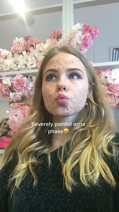 Teenage phases i regret #baddecisions #acne
