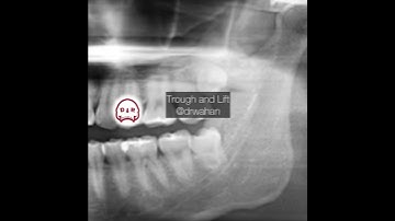 Wisdom Tooth Extraction with a Buccal Trough: Black and White Version