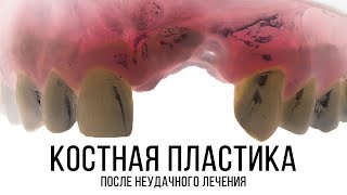 Костная пластика ламинатами после неудачной имплантации. Autogenous lamina GBR after implant failure