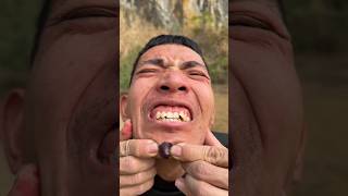 How I Cured a Bug Bite with Yogurt in theWild | Survival Hacks🥳😚😆#shotrs