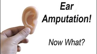 How To Take Care of an Ear Amputation to Maximize Chance of Successful Surgical Replantation