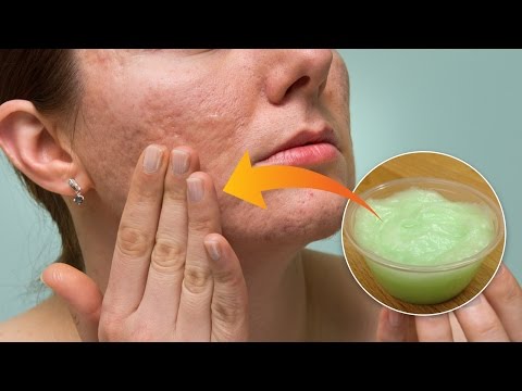 Natural Homemade Gel For Treating Stretch Marks, Wrinkles, Burns And Blemishes
