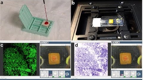 Cell block Preparation Method using Cytolyt Fixative