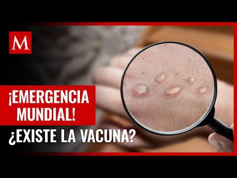 Video: ¿Puede la viruela vacuna infectar a los humanos?