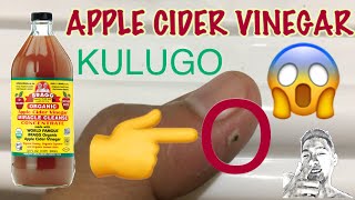 KULUGO ( WARTS ) PART II | PAANO MATANGGAL ANG KULUGO KULUGO ( WARTS ) PART II | PAANO MATANGGAL ANG KULUGO