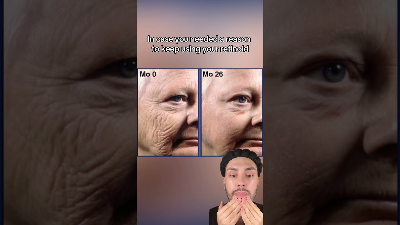 The Impacts Of Retinoids On Your Skin | Before and Afters | MaximumSkin