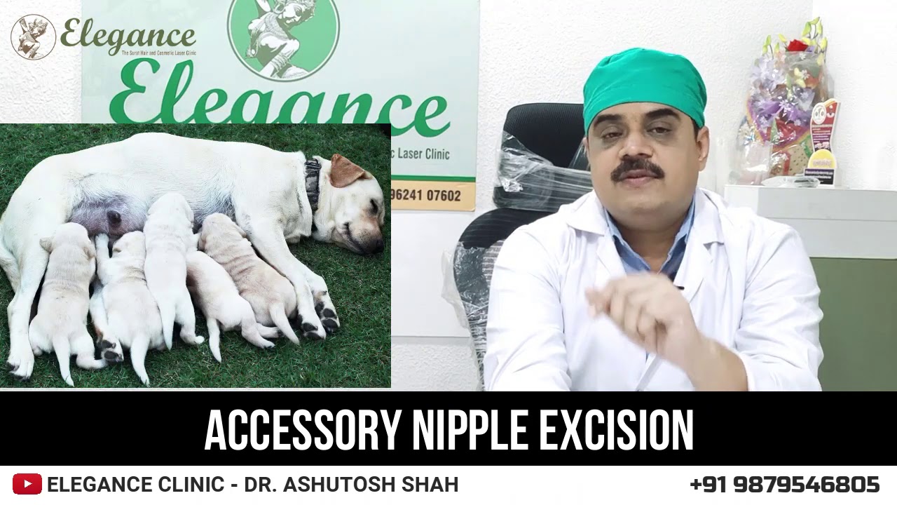 Accessory Nipple Excision, Breast Surgery By Dr. Ashutosh Shah