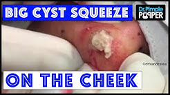 A Big Cyst SQUEEZE on the cheek: From reddit popping! 