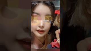 에프오성형외과 윤곽경과 | 튀어나온 광대 고민이에요!