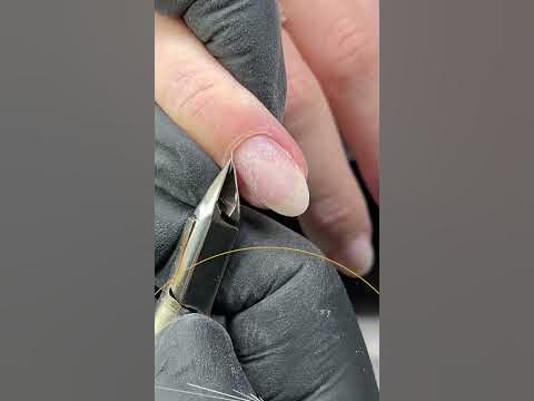 Аппарат Doktor Alex - YouTube