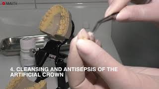 Attaching artificial crown to a model