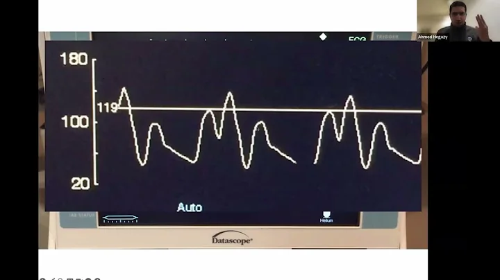 Intraaortic Balloon Pumps for the Intensivist: An IABP Primer