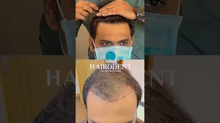 3200 ഗ്രാഫ്റ്റ് ചെയ്തു 12 മാസം കഴിയുമ്പോൾ ✅ #drsreenath #hairodent #hairtransformation