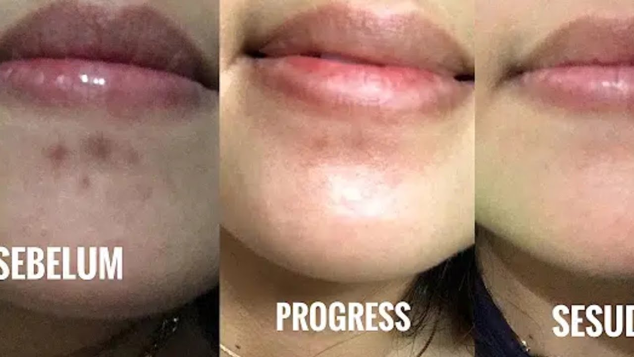 CARA MENGHILANGKAN BEKAS JERAWAT HITAM , DAN KEMERAHAN HILANG, ALAMI