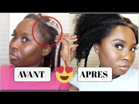Vidéo: Perte De Cheveux Sur Les Tempes: Causes Et Traitement
