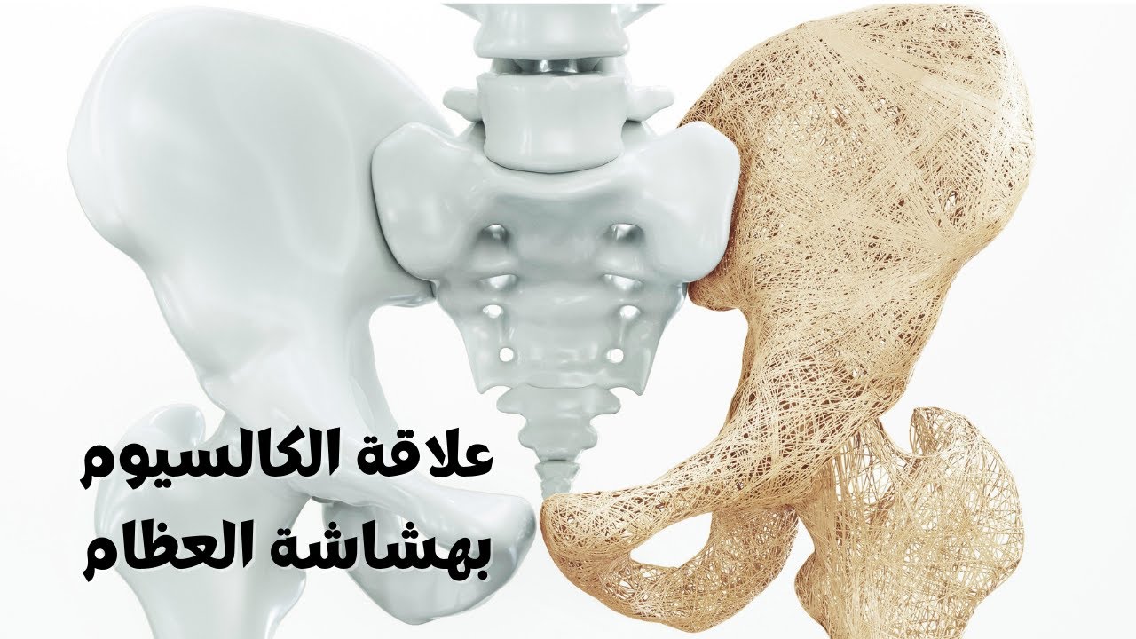 تشخيص هشاشة العظام: هل نسبة الكالسيوم تشخص هشاشة العظام؟