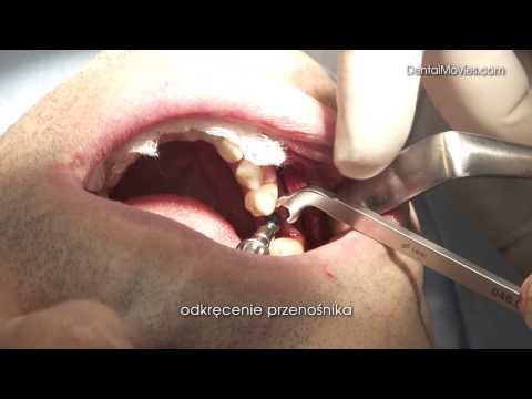 Wideo: Wpływ Materiałów Rdzenia Do Produkcji Rdzenia Implantów Dentystycznych Na Cytokompatybilność In Vitro Komórek MC3T3-E1