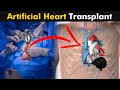 How does Artificial Heart transplant surgery works? | Artificial Hearts (Urdu/Hindi)