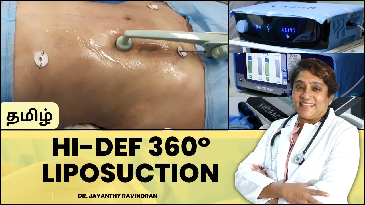 360° Liposuction HiDef 3in1 Liposuction Liposuction Treatment in