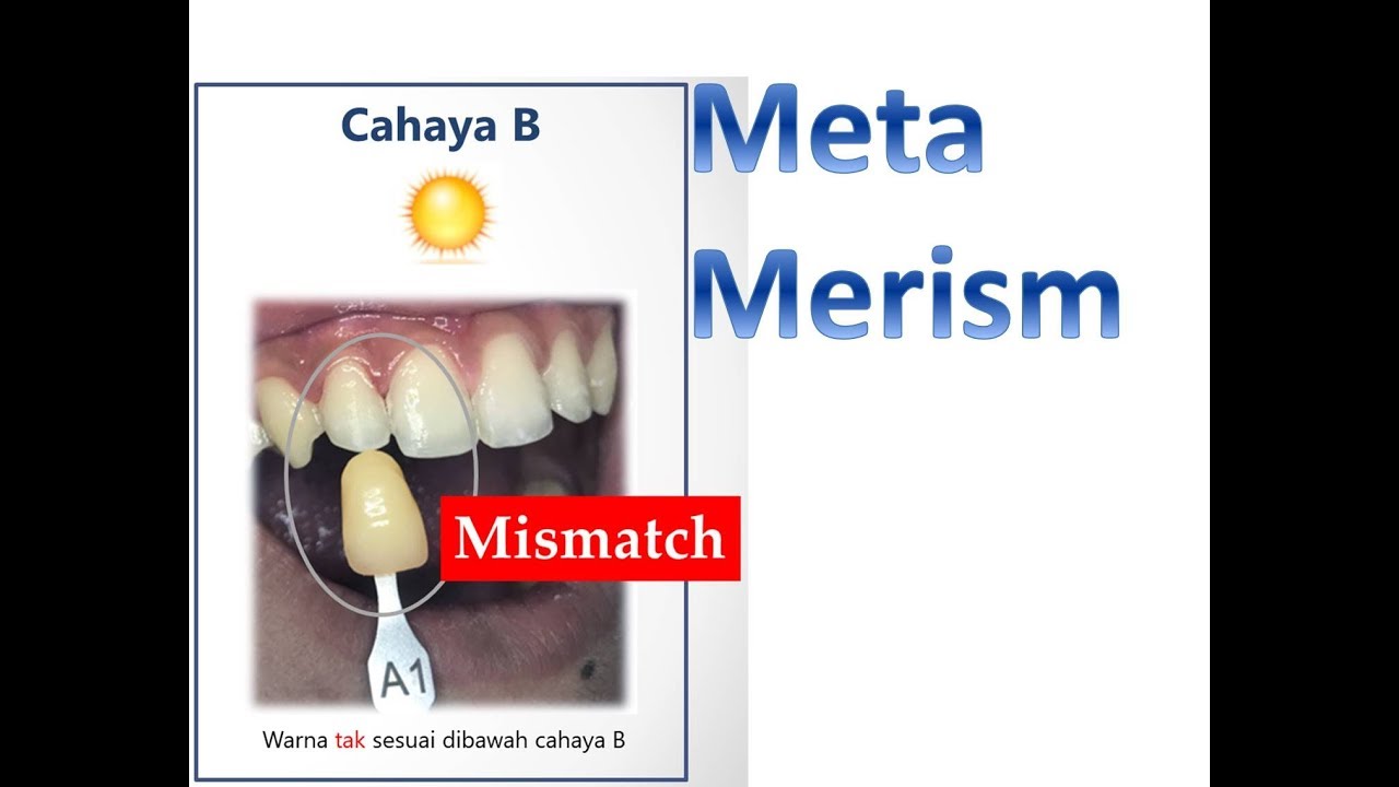 Metamerism pada dunia dental : problem dan proposal solusi - YouTube