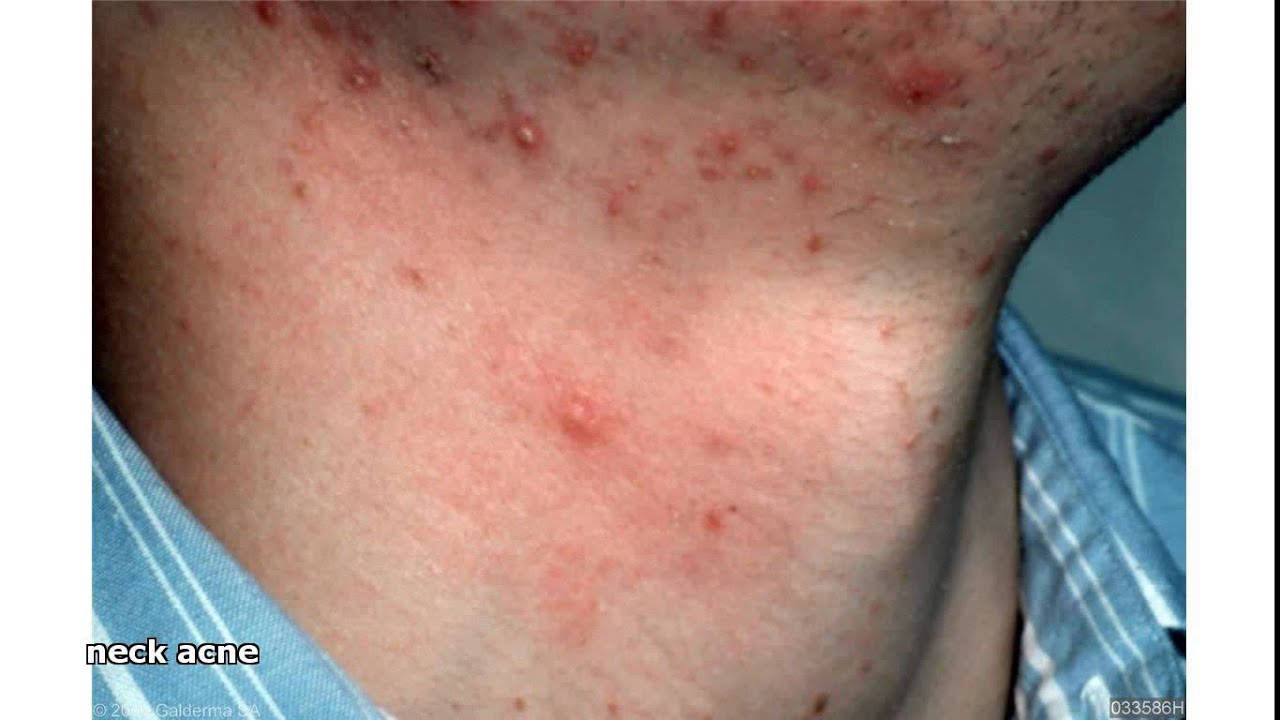 neck acne YouTube