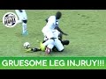 Luis garrido gruesome leg injury  honduras vs mexico