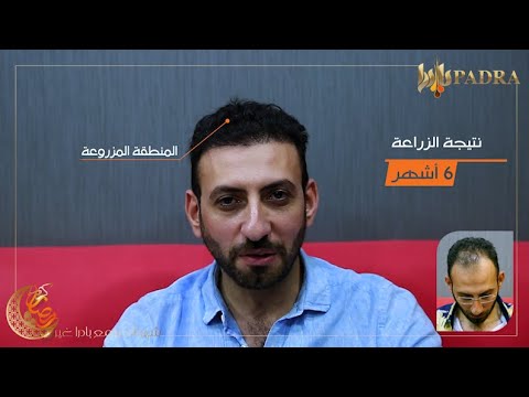 احدا عملائنا نتيجه لزراعة الشعر بادرا كلينك